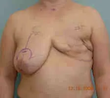 Breast Reconstruction Before and After Pictures Columbia, SC