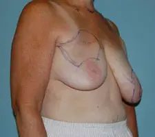 Breast Reconstruction Before and After Pictures Columbia, SC