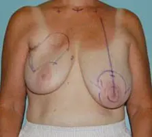Breast Reconstruction Before and After Pictures Columbia, SC