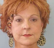 Facelift Before and After Pictures Columbia, SC