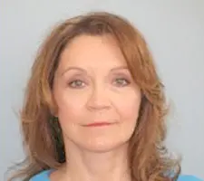 Facelift Before and After Pictures Columbia, SC