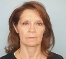 Facelift Before and After Pictures Columbia, SC