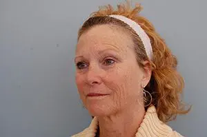 Facelift Before and After Pictures Columbia, SC