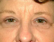 Blepharoplasty Before and After Pictures Columbia, SC