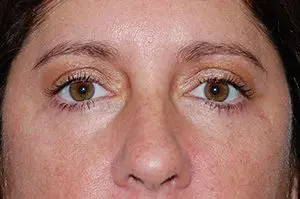 Blepharoplasty Before and After Pictures Columbia, SC