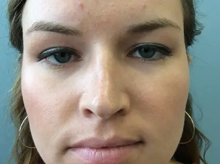 Rhinoplasty Before and After Pictures Columbia, SC
