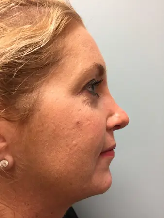 Rhinoplasty Before and After Pictures Columbia, SC