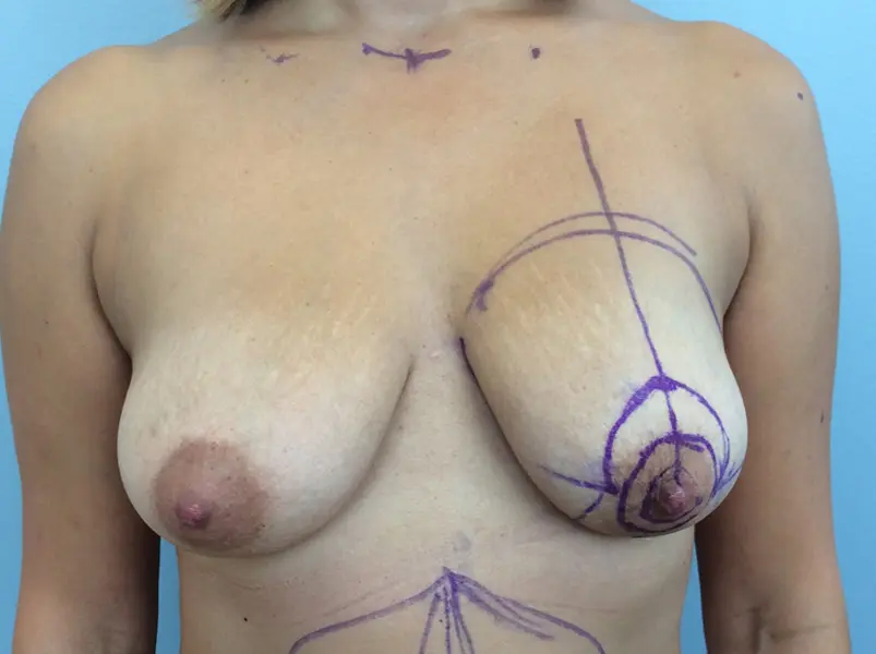 Breast Lift with Augmentation Before and After Pictures Columbia, SC