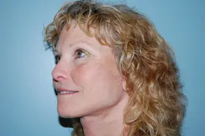 Facelift Before and After Pictures Columbia, SC