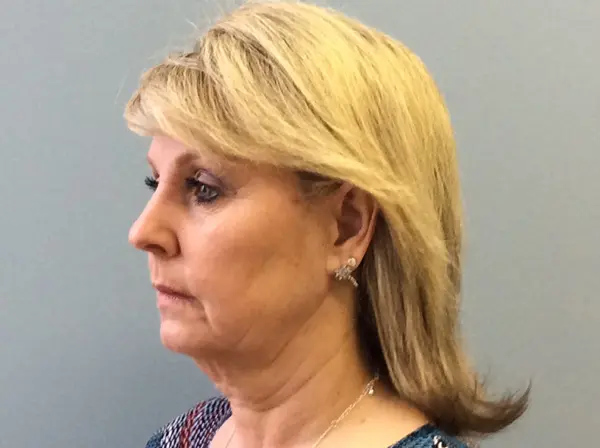 Facelift Before and After Pictures Columbia, SC