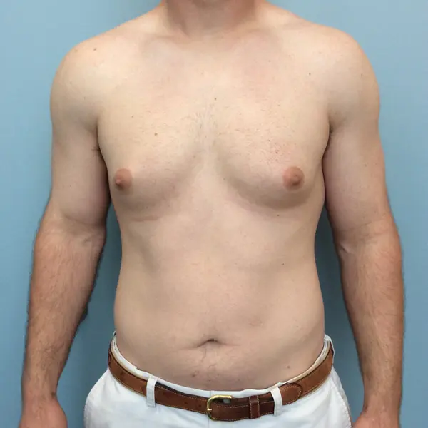 Gynecomastia Before and After Pictures Columbia, SC