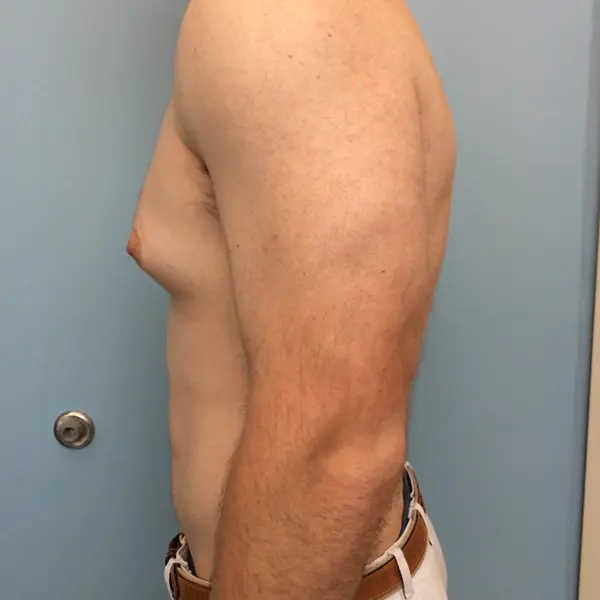 Gynecomastia Before and After Pictures Columbia, SC
