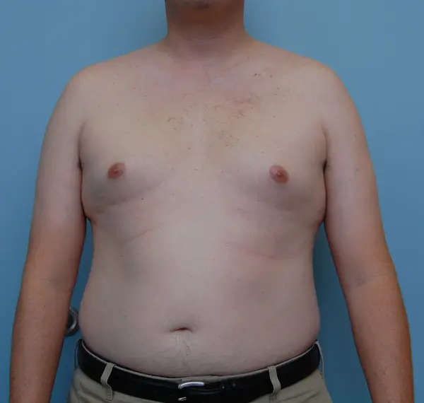 Gynecomastia Before and After Pictures Columbia, SC