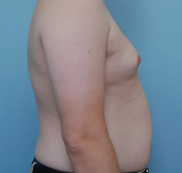 Gynecomastia Before and After Pictures Columbia, SC
