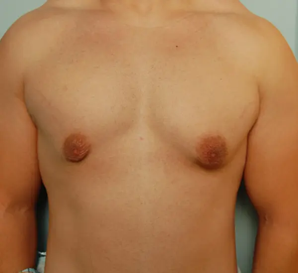 Gynecomastia Before and After Pictures Columbia, SC