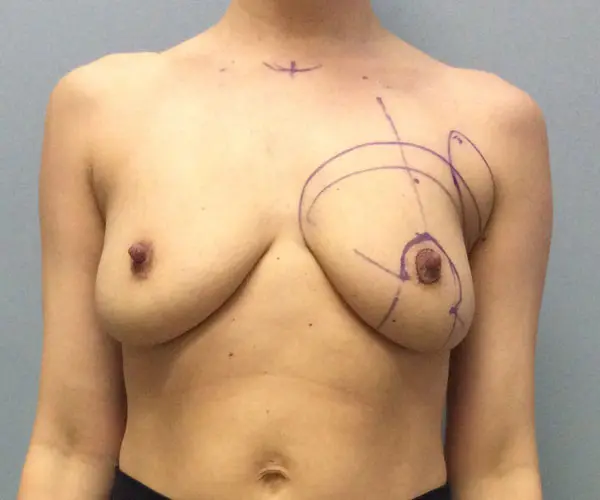 Breast Lift Before and After Pictures Columbia, SC