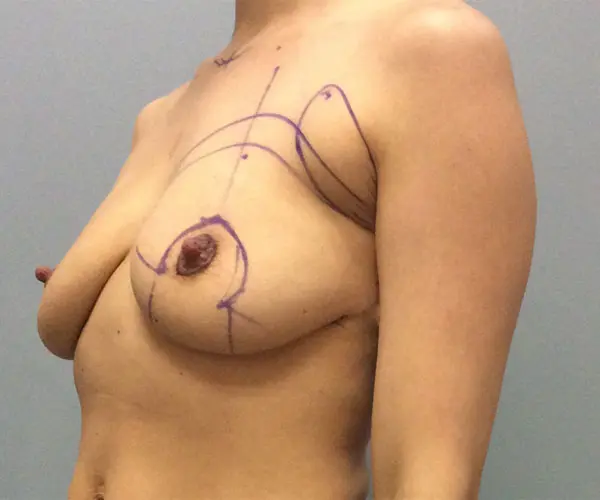 Breast Lift Before and After Pictures Columbia, SC