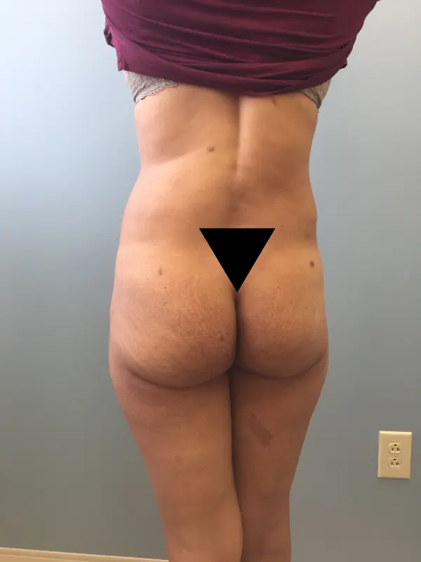 Liposuction Before and After Pictures Columbia, SC