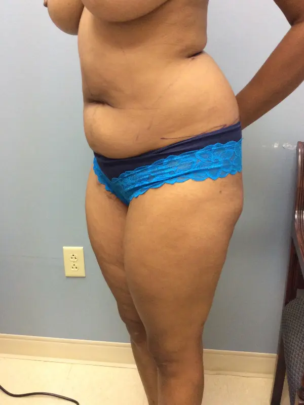 Liposuction Before and After Pictures Columbia, SC