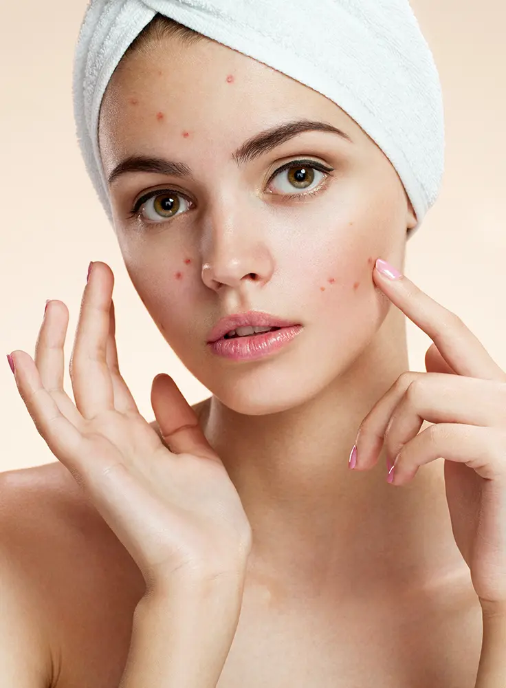 Acne Treatments in Columbia, SC