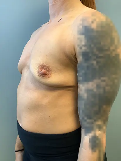 Breast Augmentation Before and After Pictures in Columbia, SC